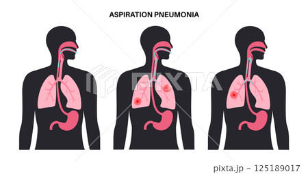 Aspiration pneumonia poster 125189017