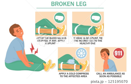 Clear instructions are provided for treating a broken leg, including applying a splint, using a cold compress, and calling for emergency assistance promptly 125195070