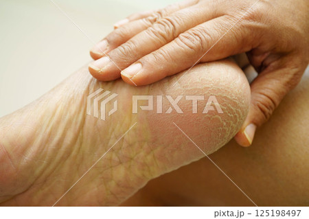Asian woman check feet with crack and dry heel skin, Diabetic Foot. Asian woman check feet with crack and dry heel skin, Diabetic Foot. 125198497