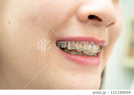 Asian woman wearing Hawley retainer removable orthodontic appliance maintain position of teeth. 125199899