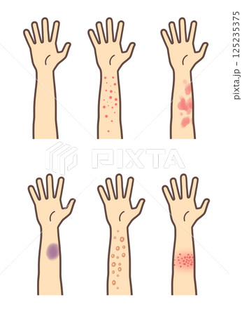 帯状疱疹や湿疹、膿疱、アザができた腕のセット 125235375