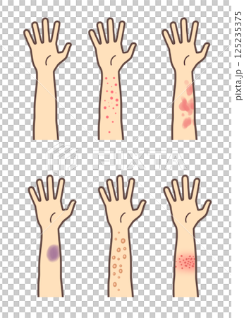 帯状疱疹や湿疹、膿疱、アザができた腕のセット 125235375