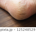 乾燥してひび割れした右足のかかと 125248529