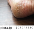 乾燥してひび割れした右足のかかと 125248530