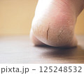乾燥してひび割れした右足のかかと 125248532