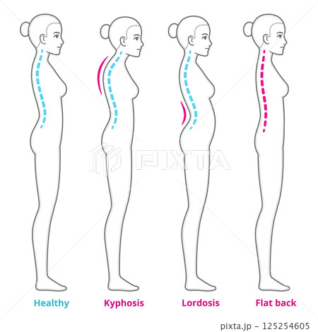 Posture and back problems spine infographic 125254605