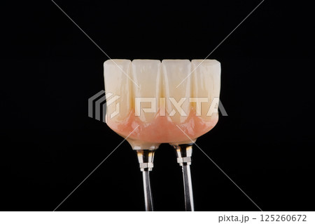 Dental bridge with artificial gum made of zirconium on two titanium abutments to fixation on implant Dental bridge with artificial gum made of zirconium on two titanium abutments to fixation on implant 125260672