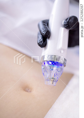 Microneedle RF lifting procedure. Hardware cosmetology. 125280287