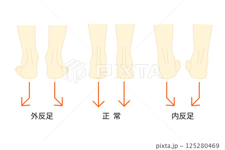正常な足と外反足・内反足のイラストセット 125280469