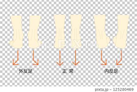 正常な足と外反足・内反足のイラストセット 125280469