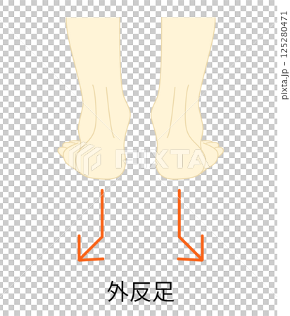 外反足のイラスト 125280471