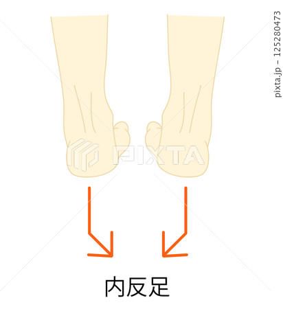 内反足のイラスト 125280473