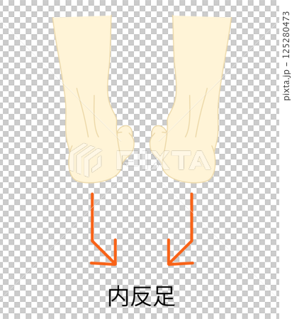 内反足のイラスト 125280473