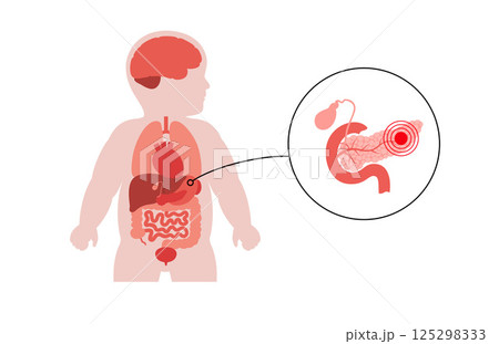 Pancreas diseases in a child 125298333