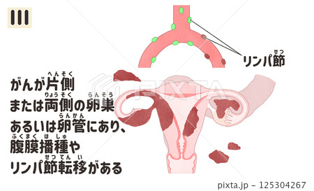 卵巣がん ステージⅢ(3期) わかりやすい日本語図解イラスト 卵巣がん ステージⅢ(3期) わかりやすい日本語図解イラスト 125304267