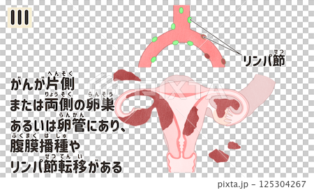 卵巣がん ステージⅢ(3期) わかりやすい日本語図解イラスト 卵巣がん ステージⅢ(3期) わかりやすい日本語図解イラスト 125304267