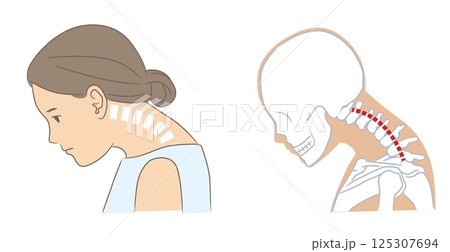 頚椎後弯で首が上がらない女性の頭部と骨格 頚椎後弯で首が上がらない女性の頭部と骨格 125307694