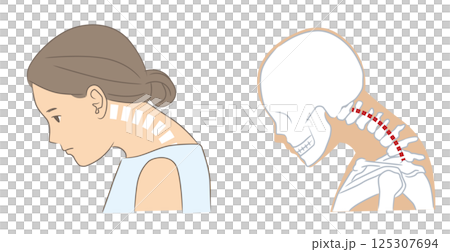 頚椎後弯で首が上がらない女性の頭部と骨格 頚椎後弯で首が上がらない女性の頭部と骨格 125307694