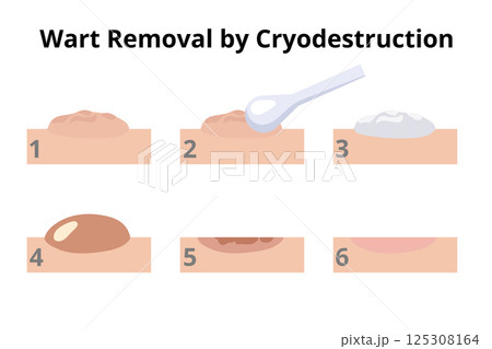 Dermatologist removing wart using cryodestruction procedure in six steps 125308164