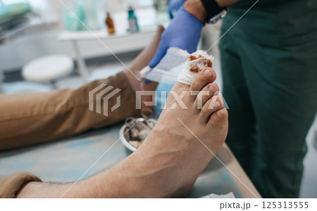 Resection of the nail plate, removal of ingrown nail. Dressing after surgery on the toe. Surgical treatment of onychocryptosis, paronychia and purulent disease 125313555
