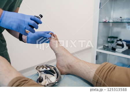 Resection of the nail plate, removal of ingrown nail. Dressing after surgery on the toe. Surgical treatment of onychocryptosis, paronychia and purulent disease 125313588