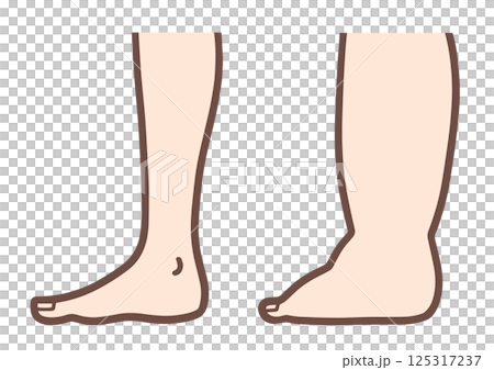 Comparison of normal and swollen feet Comparison of normal and swollen feet 125317237