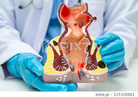 Asian doctor with rectum and hemorrhoid human anatomy model at hospital, inflamed vascular structure. 125320881
