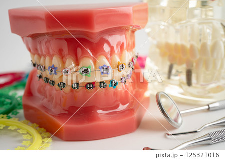 Orthodontic ligatures rings and ties, elastic rubber bands on orthodontic braces, model for dentist studying about dentistry. Orthodontic ligatures rings and ties, elastic rubber bands on orthodontic braces, model for dentist studying about dentistry. 125321016
