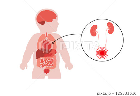 Kidney diseases in a child 125333610