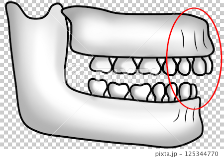 Abnormal jawbone structure with protruding upper jaw causing an overbite Abnormal jawbone structure with protruding upper jaw causing an overbite 125344770