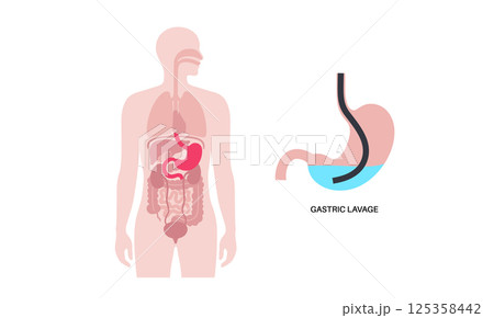 Stomach wash gastric lavage 125358442