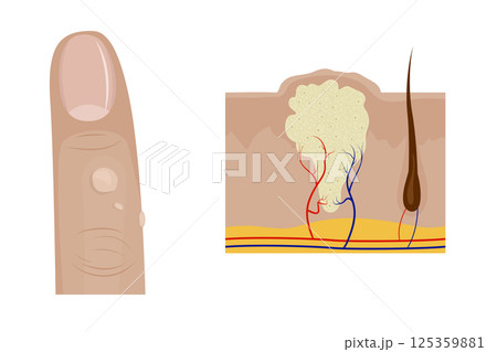 Common warts growing on finger and cross section of wart anatomy Common warts growing on finger and cross section of wart anatomy 125359881