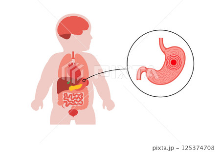 Stomach diseases in a child Stomach diseases in a child 125374708