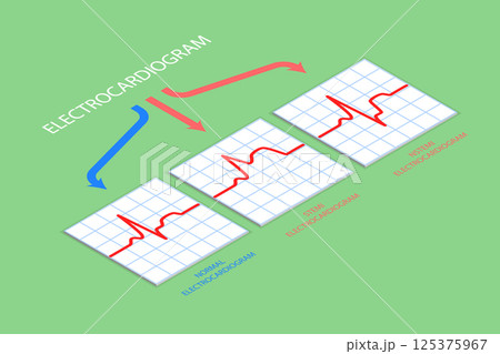 3D Isometric Flat Vector Illustration of Electrocardiogram, Diagnostics and Healthcare 125375967