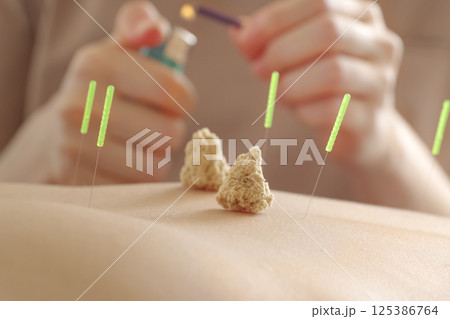鍼灸院のお灸治療 鍼灸院のお灸治療 125386764