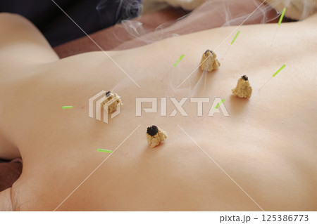 鍼灸院のお灸治療 鍼灸院のお灸治療 125386773