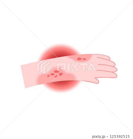 Red rash and itchy on hand cartoon for illustration and health care. Allergy and medical concept Red rash and itchy on hand cartoon for illustration and health care. Allergy and medical concept 125392515