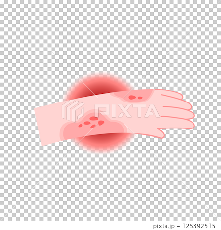 Red rash and itchy on hand cartoon for illustration and health care. Allergy and medical concept Red rash and itchy on hand cartoon for illustration and health care. Allergy and medical concept 125392515