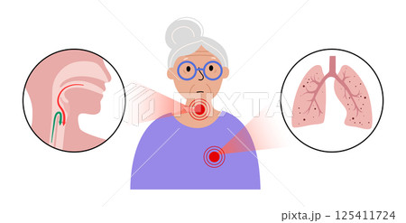 Aspiration pneumonia poster Aspiration pneumonia poster 125411724