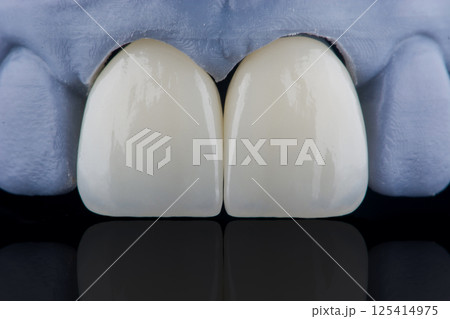High-quality naturally dental single crowns made of zirconium for fixation to the frontal teeth of upper jaw. 125414975