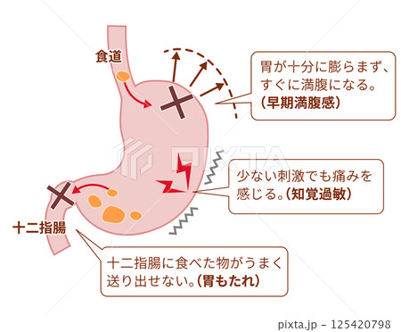 機能性ディスペプシア（FD）の症状と仕組みの説明図 125420798