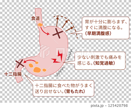 機能性ディスペプシア（FD）の症状と仕組みの説明図 125420798