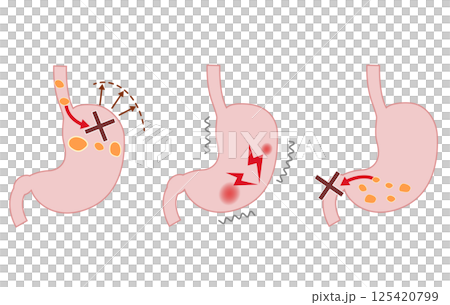 Diagram of the symptoms and mechanism of functional dyspepsia (FD) Diagram of the symptoms and mechanism of functional dyspepsia (FD) 125420799
