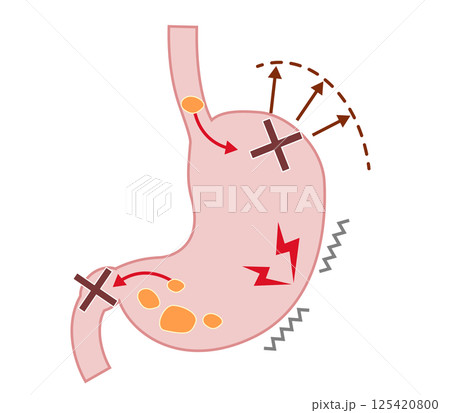 機能性ディスペプシア（FD）の症状と仕組みの説明図 125420800