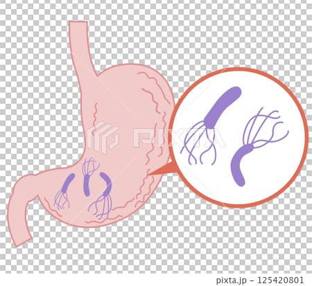 Stomach infected with Helicobacter pylori 125420801