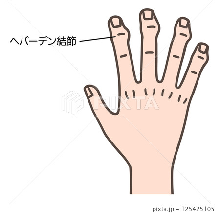 ヘバーデン結節で変形した手指 125425105