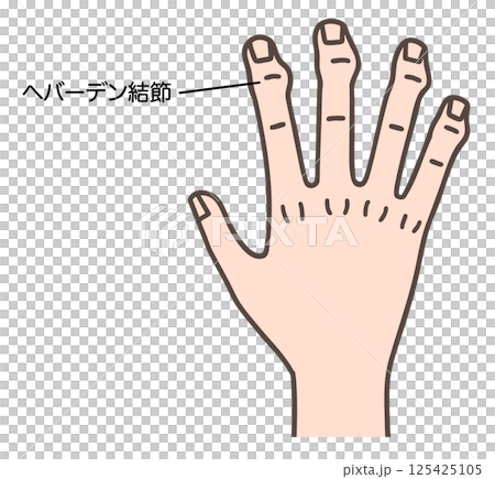 ヘバーデン結節で変形した手指 125425105
