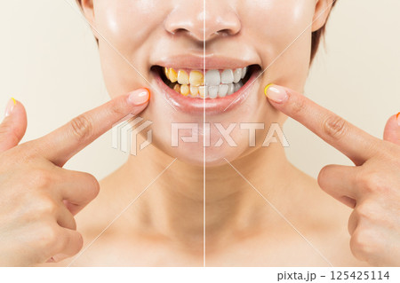 " ホワイトニングの効果 " 黄ばんだ歯と白い歯のクローズアップ相対比較. " ホワイトニングの効果 " 黄ばんだ歯と白い歯のクローズアップ相対比較. 125425114