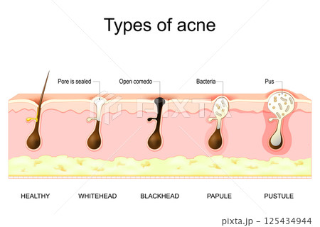 Types of acne pimples. Cross section of a human skin 125434944