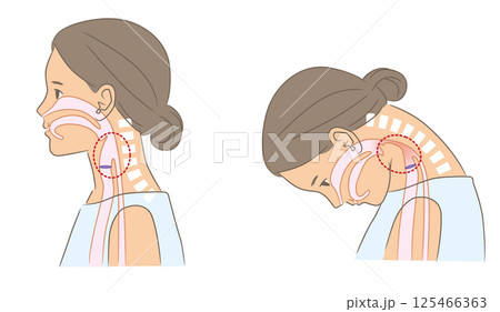 首下がり症と正常な女性の咽頭の比較イラスト 125466363
